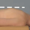 posizione paziente con bolster